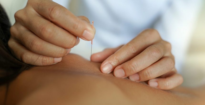 Dry Needling vs. Acupuncture