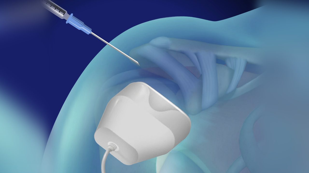 ultrasound shoulder injection